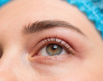 Functional Blepharoplasty