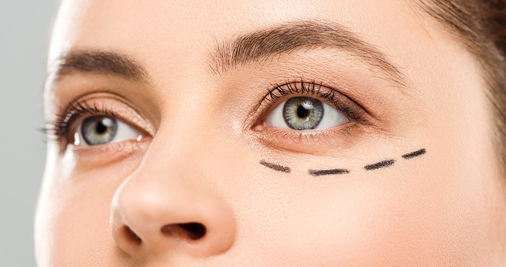 The Benefits of a Stitch-Free Eyelid Lift