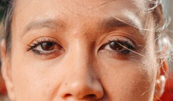 Blepharoplasty at Orbit Eye Center Dubai