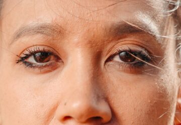 Blepharoplasty at Orbit Eye Center Dubai