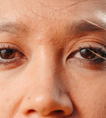 Blepharoplasty at Orbit Eye Center Dubai